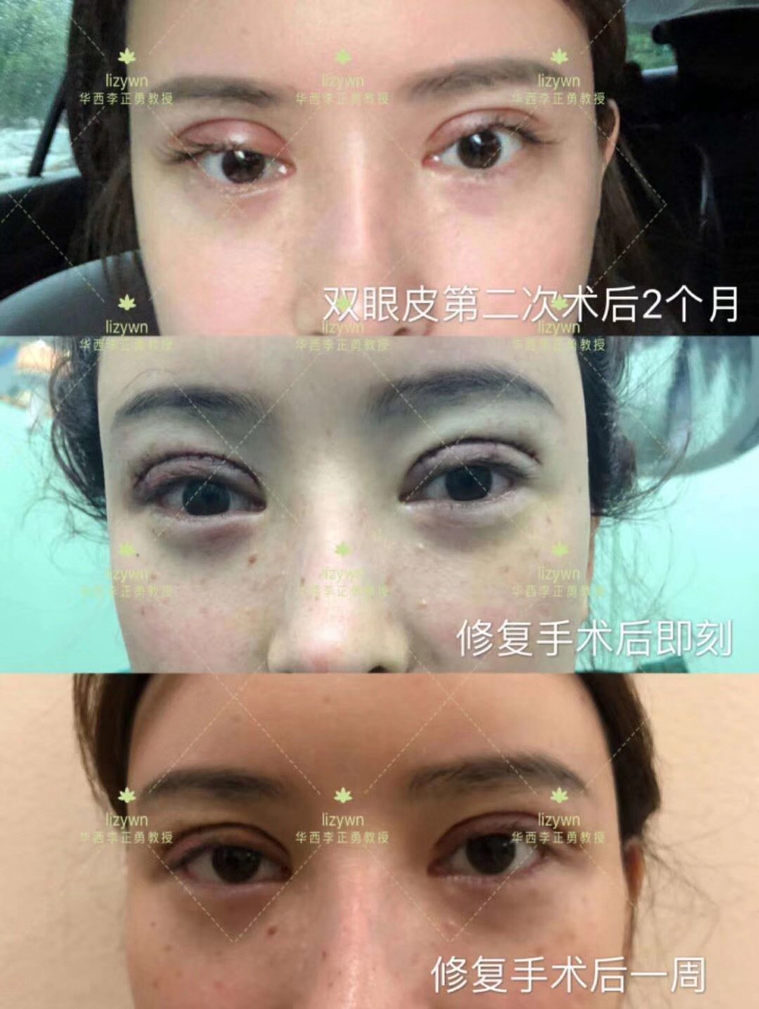 六点定位双眼皮的原理_做双眼皮的最佳时间点_五年三点定位双眼皮不成功怎么办