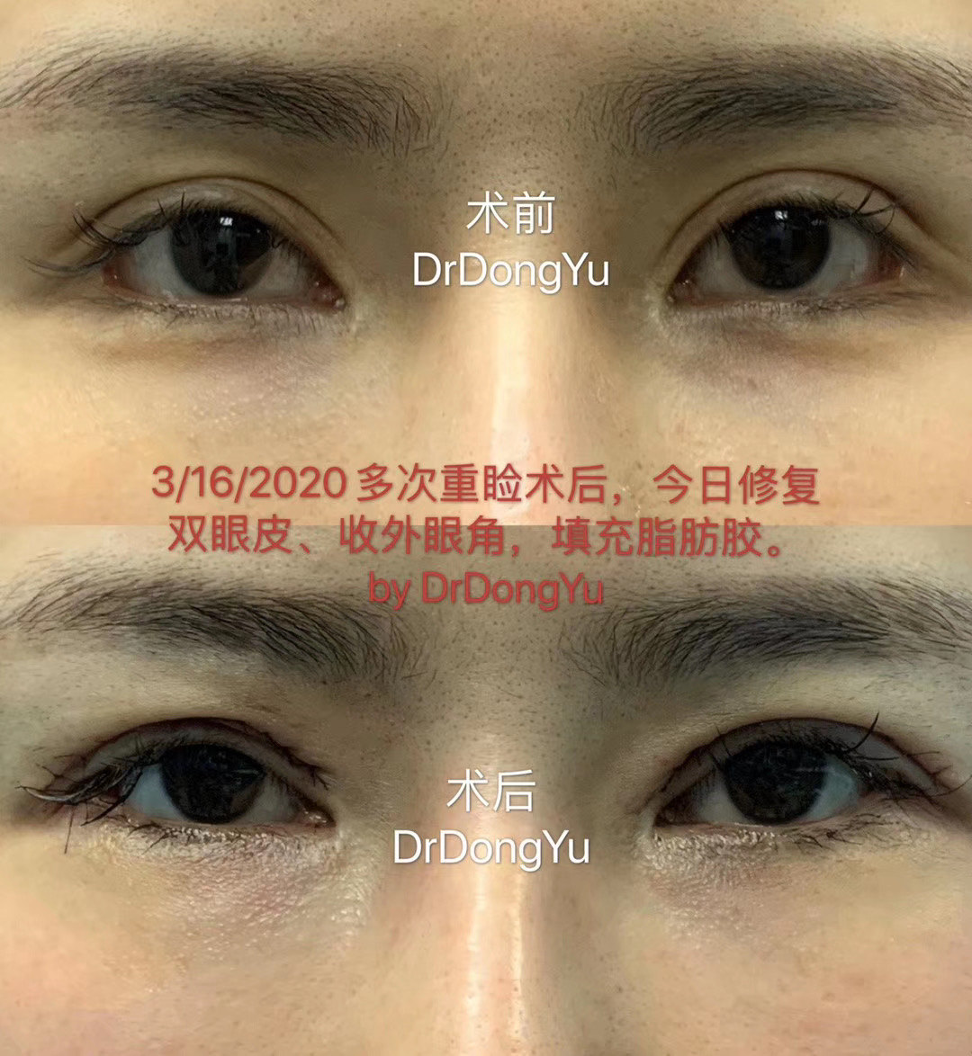 做双眼皮的最佳时间点_五年三点定位双眼皮不成功怎么办_六点定位双眼皮的原理