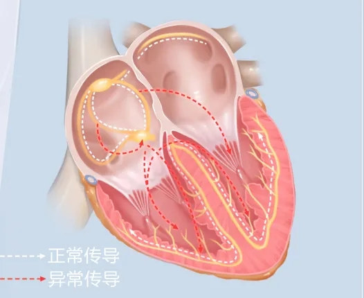 阵发性室上性心动过扑_阵发心房扑动_阵发性心房扑动吃什么药